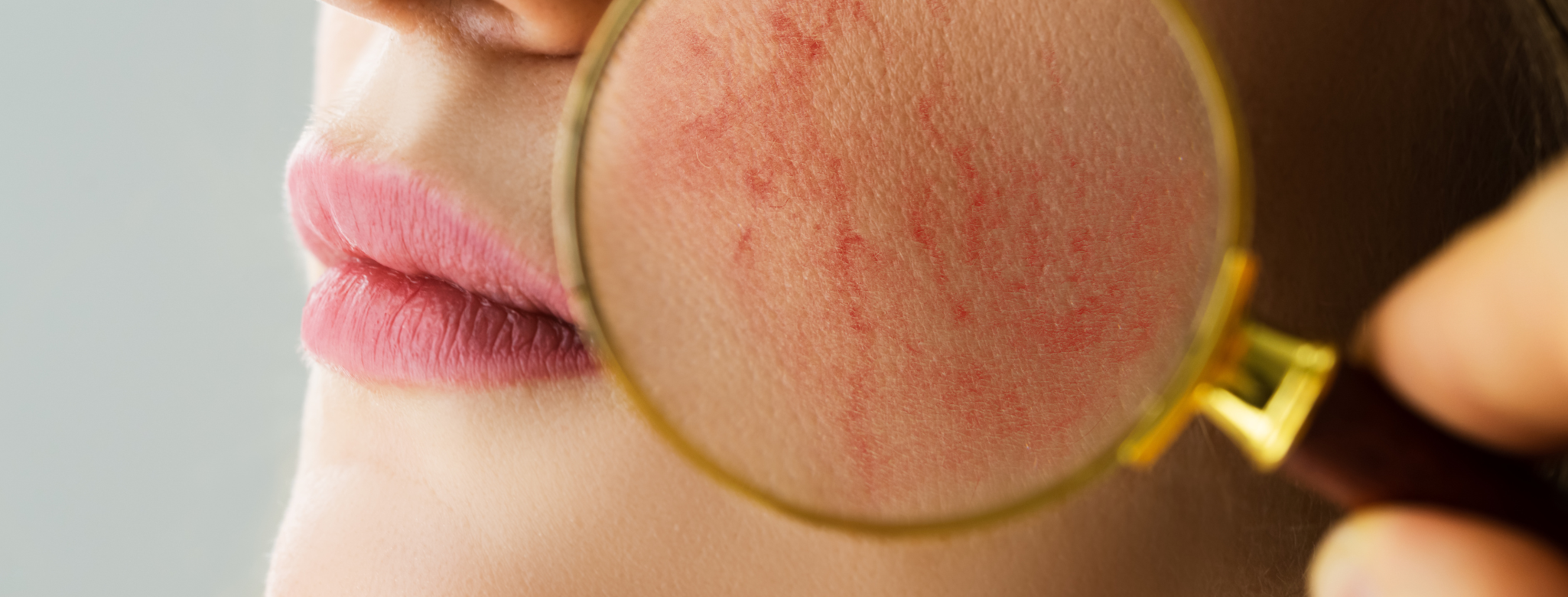 Minden, amit az arcbőr kipirosodásáról tudni kell
